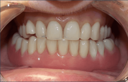  | CW Dentures